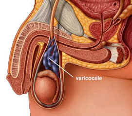 Варикоцеле - варикозное расширение вен гроздевидного сплетения левого яичка.
